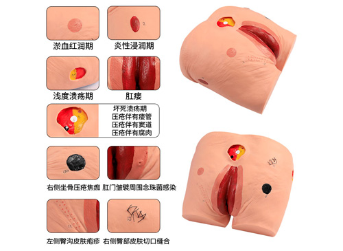 高級(jí)壓瘡（褥瘡）護(hù)理模型
