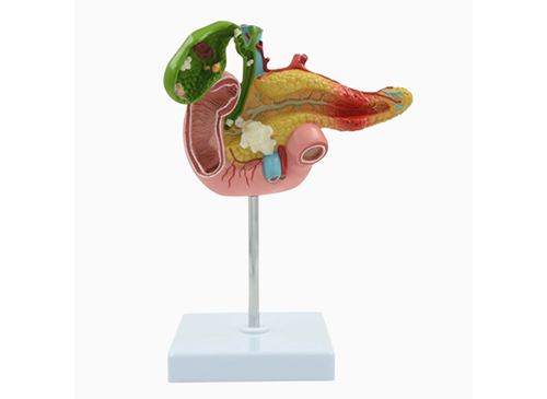 胰脾十二指腸膽囊病變模型