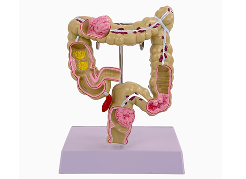 結(jié)腸病變模型