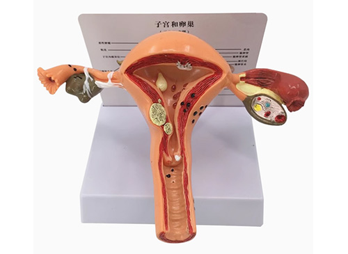 子宮卵巢病變模型